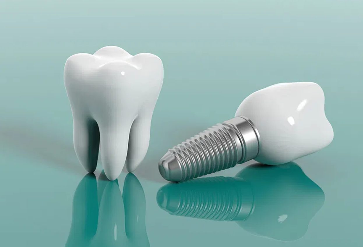 Single Tooth Implant