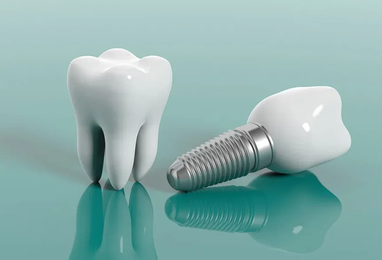 Single Tooth Implant
