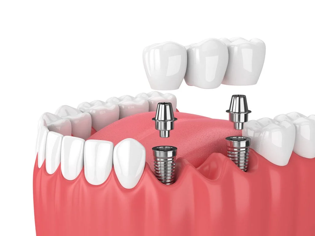 Multiple Teeth Implant