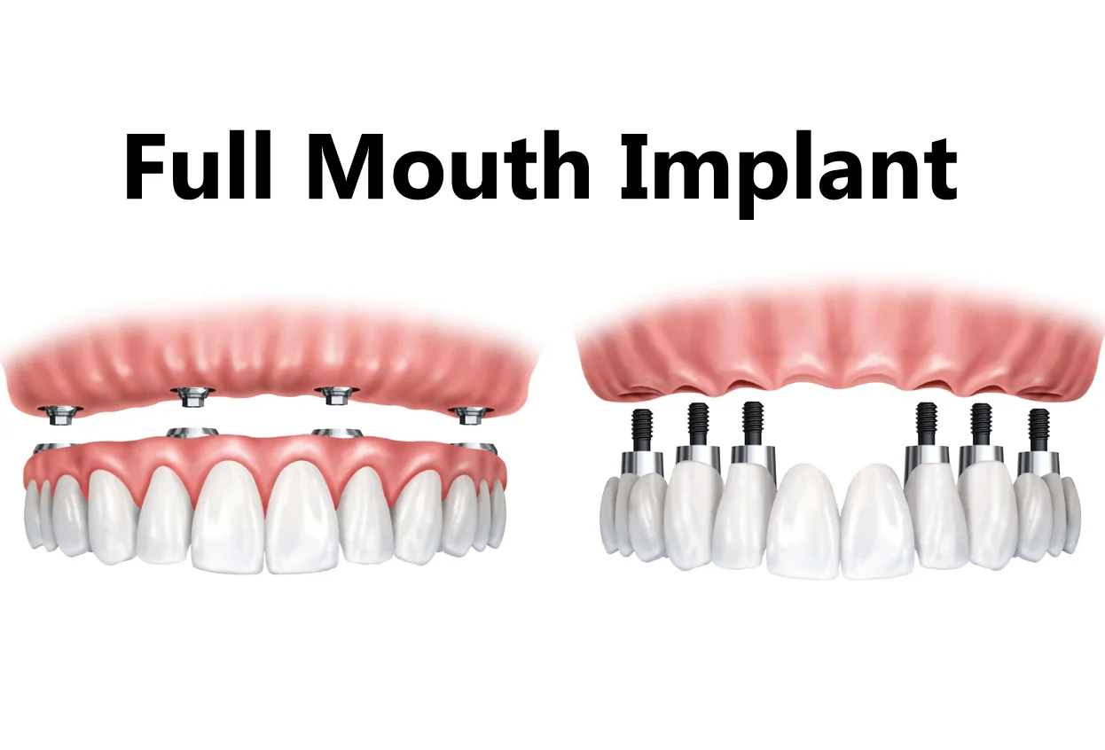 Full Teeth Implant